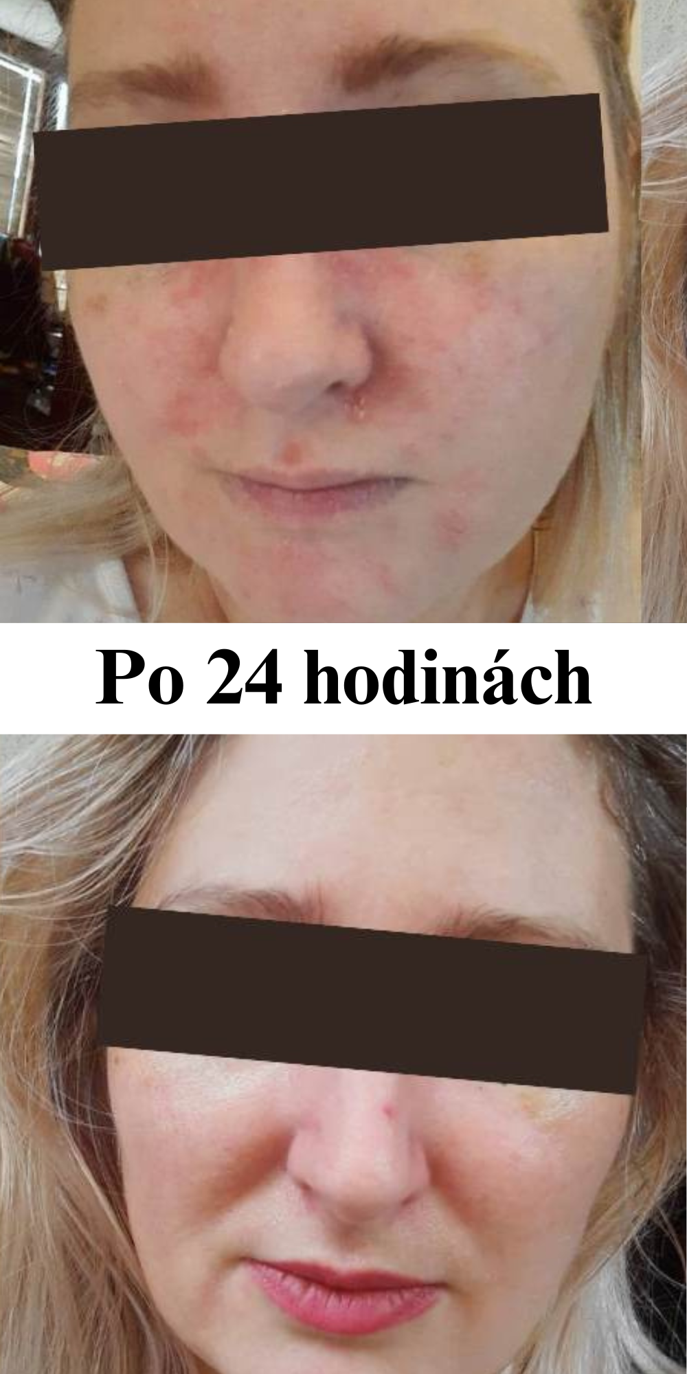 Účinky prírodnej kozmetiky Barbora Lori, pred a po, zmena už po 24 hodinách, kožné problémy
